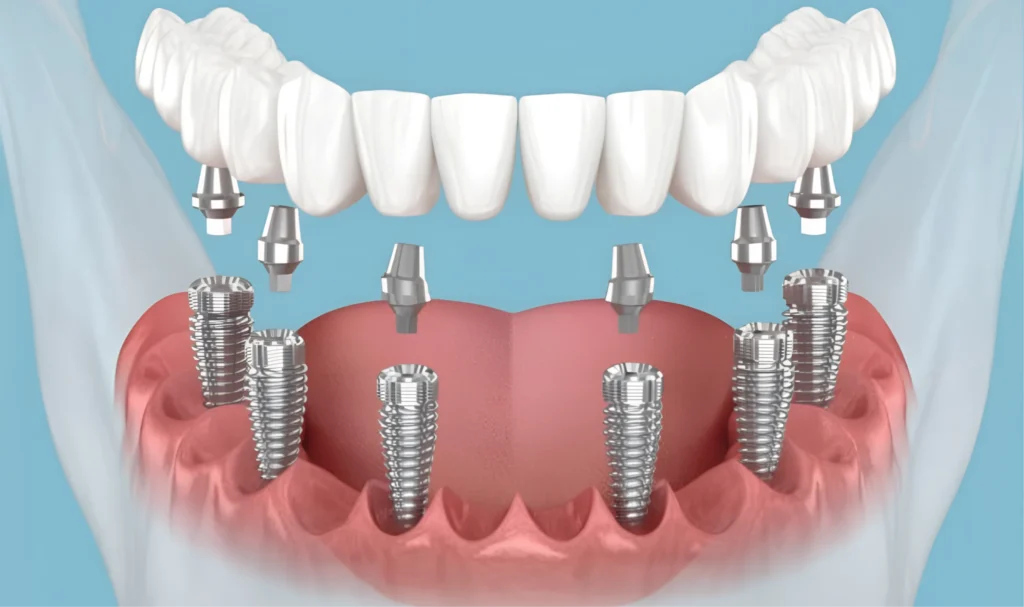 implantes de carga imediata